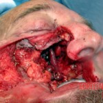 Surgical face reconstruction