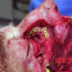 Surgical face reconstruction