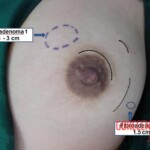 Fibroadenomas surgery