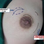 Fibroadenomas surgery