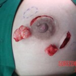 Fibroadenomas surgery