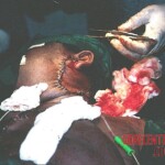 Surgical removal of giant tumour