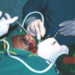 Surgical removal of giant tumour
