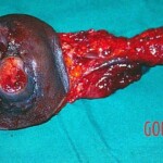 Surgical removal of giant tumour