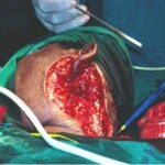 Surgical removal of giant tumour