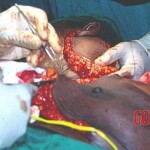Surgical removal of giant tumour