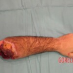 Surgical rescue of amputated arm