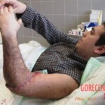 Surgical rescue of amputated arm