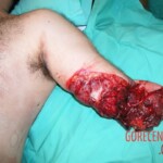 Surgical rescue of amputated arm