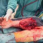 Surgical rescue of amputated arm