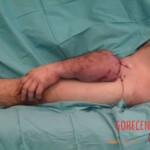 Surgical rescue of amputated arm