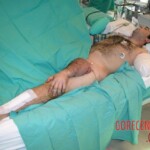 Surgical rescue of amputated arm