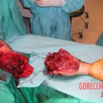 Surgical rescue of amputated arm