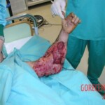 Surgical rescue of amputated arm