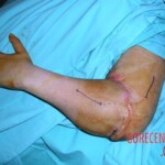 Surgical rescue of amputated arm