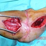 Surgical rescue of amputated arm