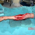Skin grafting