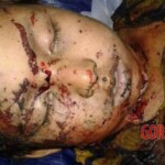 Children torn by mine