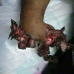 Children torn by mine