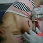 Children torn by mine