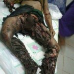 Children torn by mine