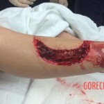 Florida shark attack