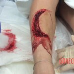 Florida shark attack