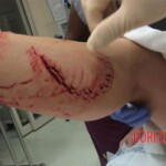 Florida shark attack