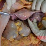 Autopsy of Chinese woman