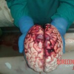 Brain extraction
