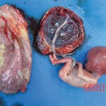 Dead pregnant anorexic