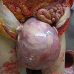 Autopsy of pregnant woman