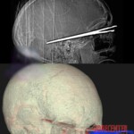 Schizophrenic woman tried to gouge out her eye with scissors