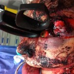 Schizophrenic woman tried to gouge out her eye with scissors