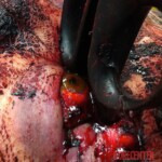 Schizophrenic woman tried to gouge out her eye with scissors