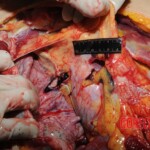 Stabbed woman in morgue