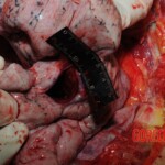 Stabbed woman in morgue