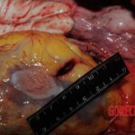 Stabbed woman in morgue