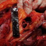 Stabbed woman in morgue