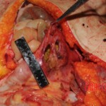 Stabbed woman in morgue