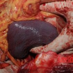 Stabbed woman in morgue