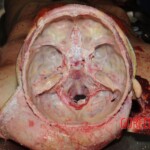 Stabbed woman in morgue