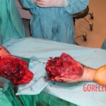 Surgical rescue of arm