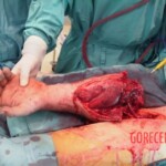 Surgical rescue of arm