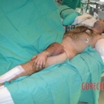 Surgical rescue of arm