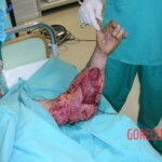 Surgical rescue of arm