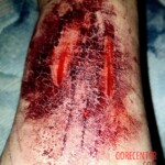 Wrist cut by blunt object