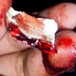 Wrist cut by blunt object