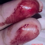 Wrist cut by blunt object