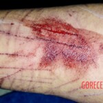 Wrist cut by blunt object